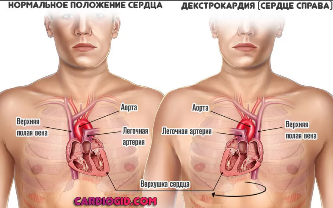 Сердечный бывать. С какойтстороныт серцн.