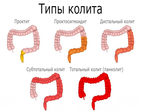   Диета  при  лечении  колита  -  дело  первостепенной  важности.