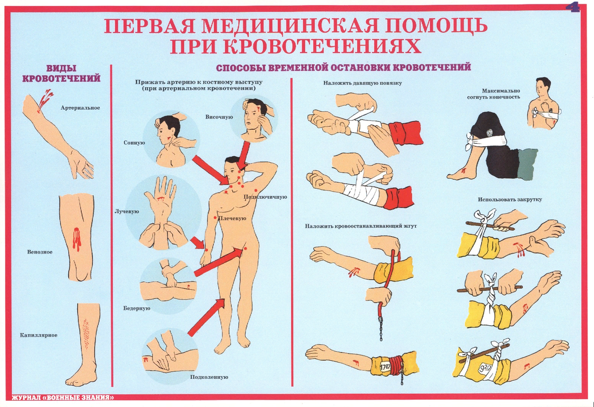 Для более продолжительной остановки кровотечения. Оказание 1 медицинской помощи при кровотечении. Памятка по оказанию первой медицинской помощи при кровотечении. Оказание первой помощи при артериальном и венозном кровотечении. Остановка кровотечения первая помощь.