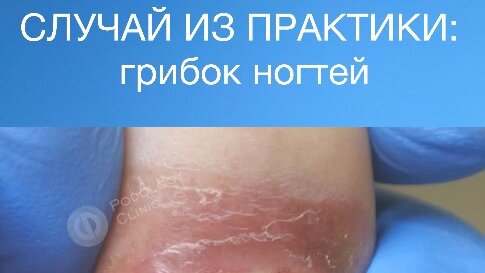 КЛИНИКА ПОДОЛОГИИ ПОЛЁТ | СЛУЧАЙ ИЗ ПРАКТИКИ: грибок ногтей / грибок на ...