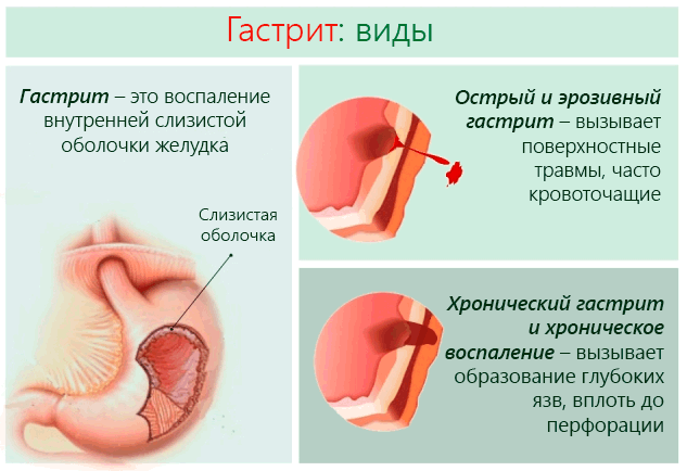 Гастрит желудка симптомы, причины и лечение у взрослых