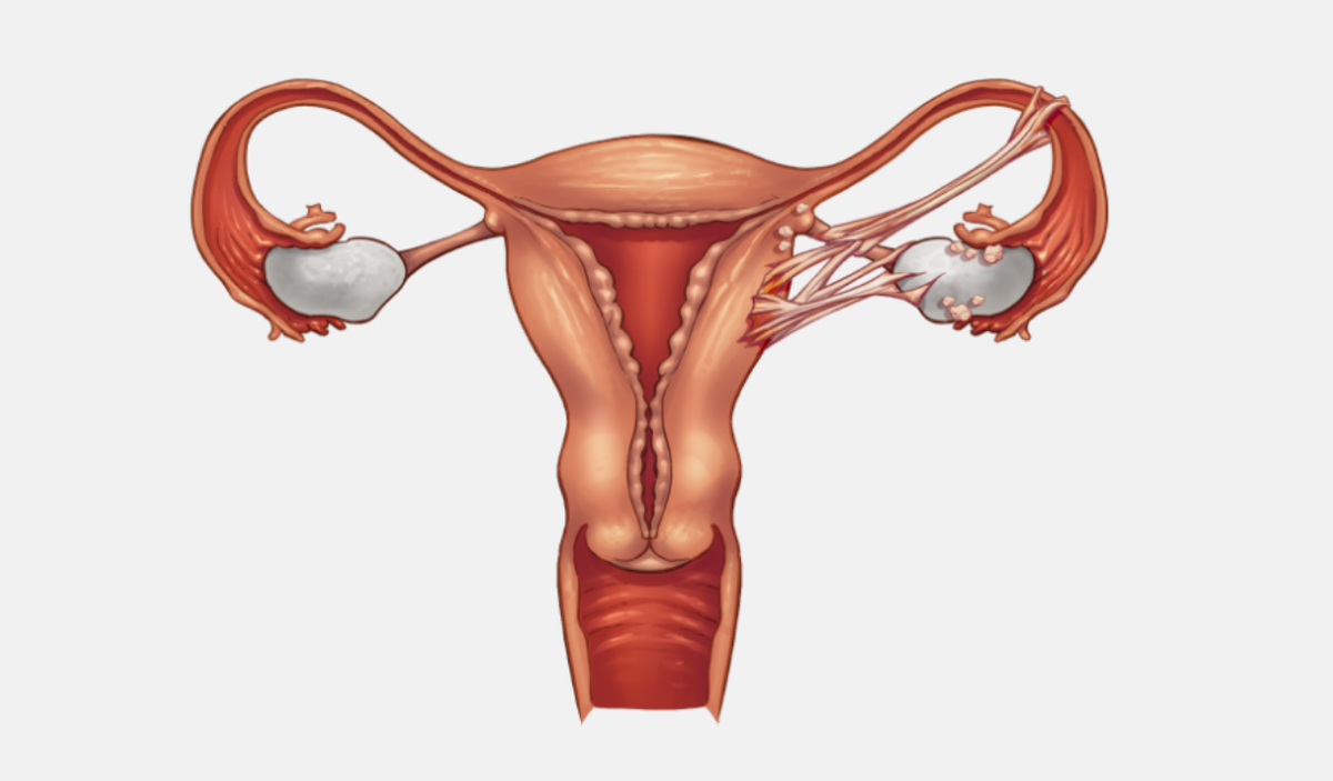 Вид эндометриоза