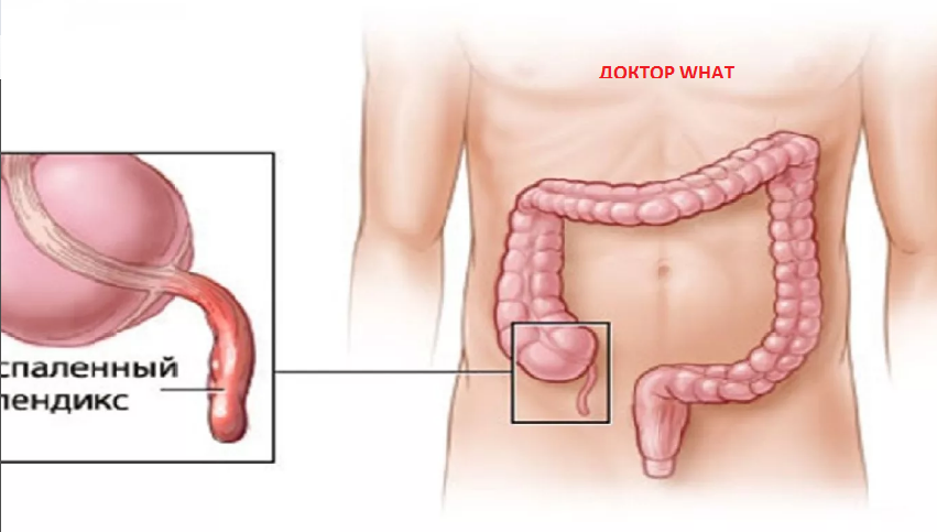 С какой стороны аппендицит