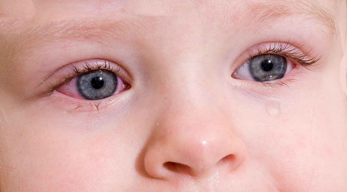    Аллергический конъюнктивит у детей представляет собой воспаление конъюнктивы (слизистой оболочки внутренней поверхности век и передней поверхности глазного яблока), которая вызвана...