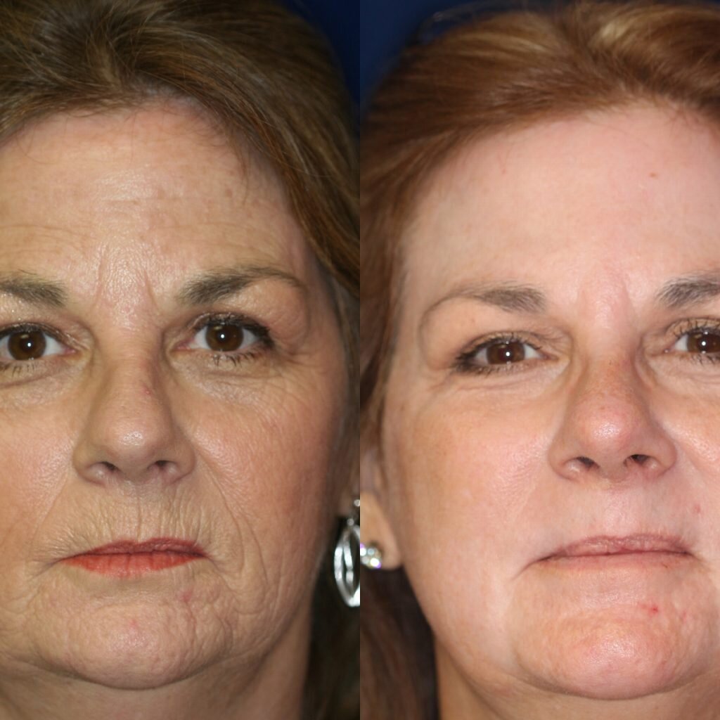 Молодость. Женщины. Привлекательность. Морщины. Омоложение. Красота.