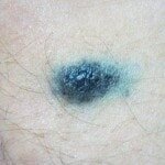 Голубая родинка свой цвет получила от уровня отражения меланина, зарождается глубоко в эпителии. Голубая родинка может вызывать рак кожи. Часто появляется в области ягодиц, а постоянное раздражение может привести к онкологическому диагнозу. Чтобы узнать о качестве родинки этого типа, следует провести биопсию. Этот анализ покажет, является ли родинка доброкачественной или уже опасной, также станет известен характер образования, что направит специалистов на путь лечения.