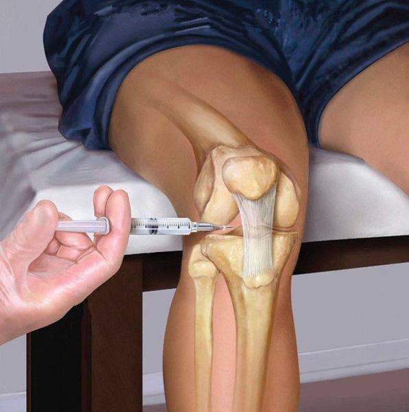 Схематично показываю, каким образом может вводиться внутрисуставная инъекция.