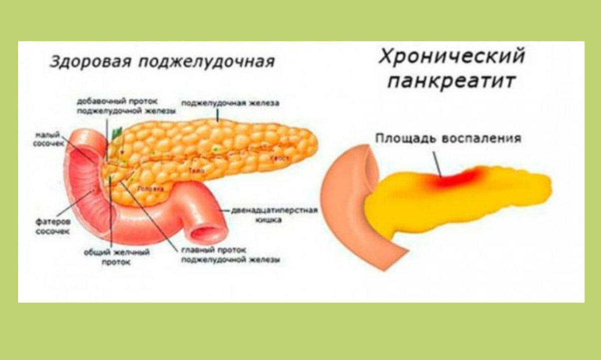 Хронические заболевания поджелудочной железы