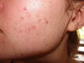 Очистит кожу и обеспечит заживление отвар из чистотела. Систематическое его применение позволяет сократить количество новых угрей. Порядок приготовления средства следующий: