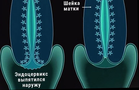 Слева - отклонение, справа - норма