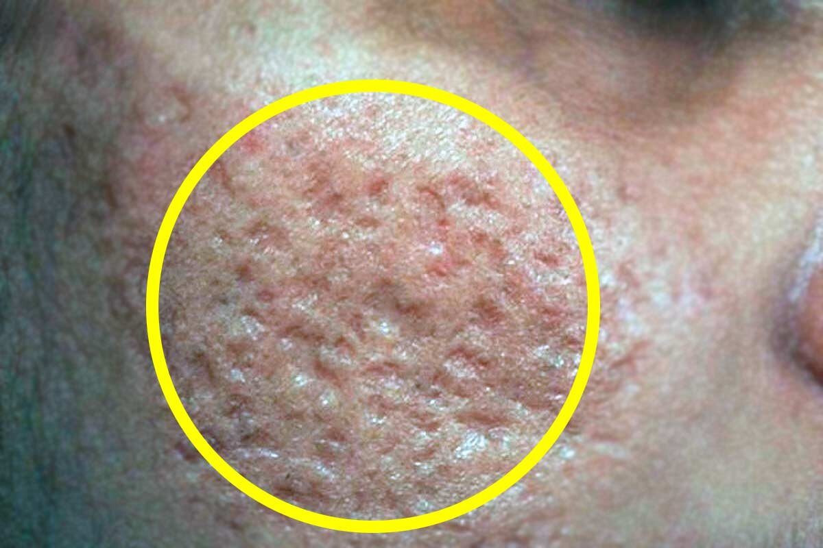 Рубцы после прыщей