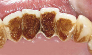 налет и камень на резцах