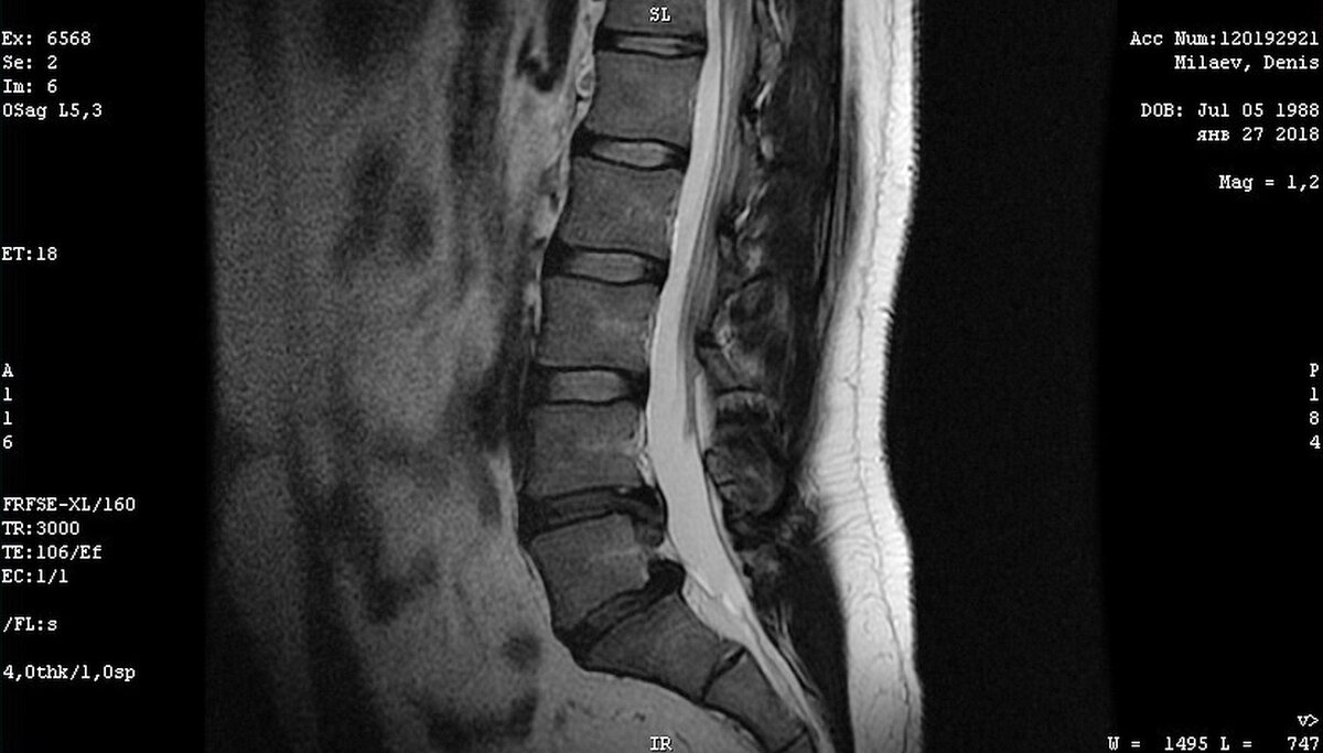 Как на мрт выглядит грыжа позвоночника фото