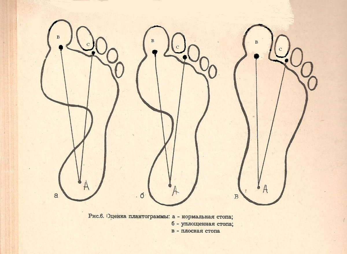 1 3 стопы. Степень плоскостопия по отпечатку стопы. Оценка плантограммы по методу в.а. Яралова-Яраленда. Измерение степени продольного плоскостопия рис. След стопы 2 степень плоскостопия.