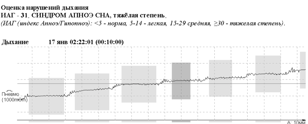 Заключение по степени тяжести выявленных нарушений дыхания во сне и пример остановок дыхания, определенных по реопневмограмме. Темным выделены апноэ, более светлым - гипопноэ. 