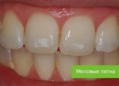 Начальная стадия кариеса