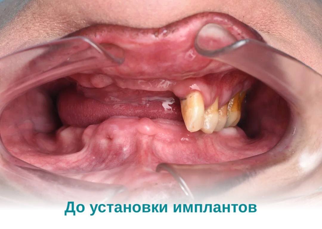 Состояние полости рта пациента до установки имплантов