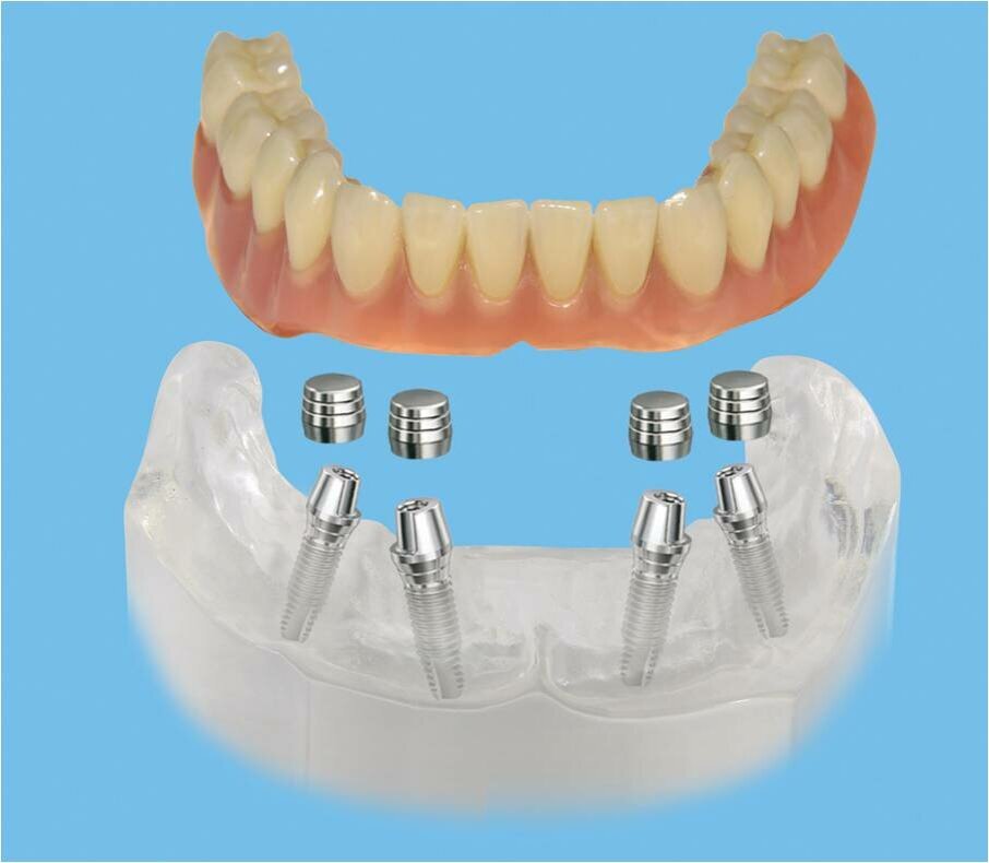 Несъемный зубной протез на 4 имплантах цена