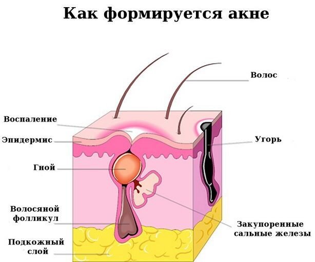 Откуда берутся прыщи на спине и как от них избавиться