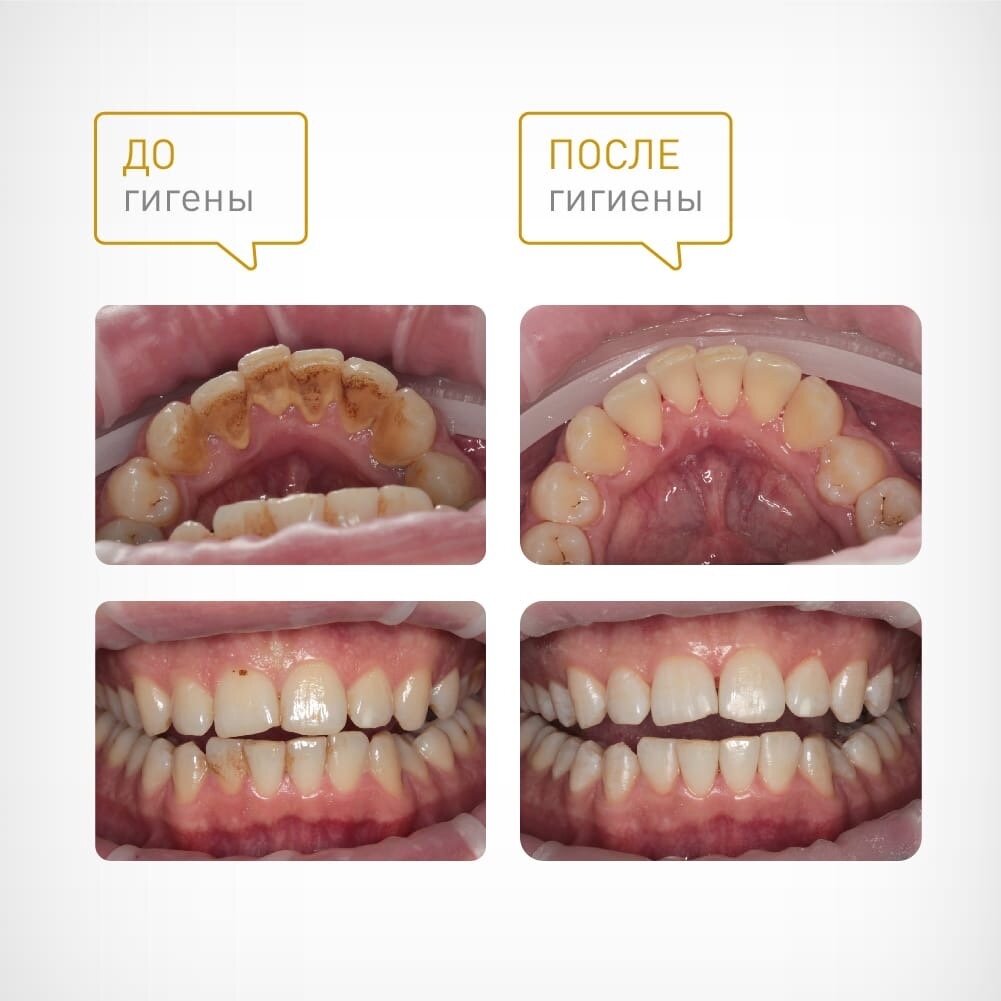 При осмотре гигиенист видит мягкий, обильный, пигментированный налет "курильщика", а также наличие твердых зубных отложений - камней. Сразу после гигиены была проведена консультация терапевта для последующего лечения.