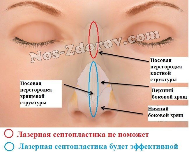 История пациентки. Зухра. Ринопластика