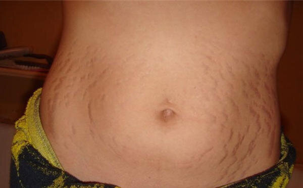 Врачи рекомендуют во время беременности особенно тщательно заботиться о своём здоровье, в том числе о внешнем виде тела. Растяжки гораздо легче предотвратить, чем вылечить, поэтому их профилактика станет правильным решением.