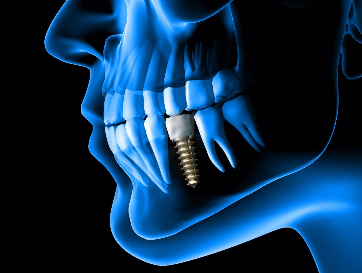 О противопоказаниях к имплантации зубов с точки зрения современной стоматологии