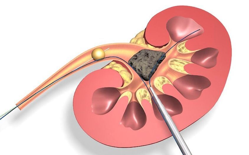 От чего появляются камни в почках и как ускорить выход камня из почки