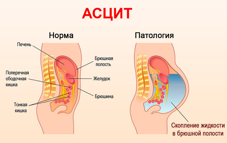 Асцит – что это, симптомы, причины, признаки и методы лечения у взрослых в «СМ-Клиника»