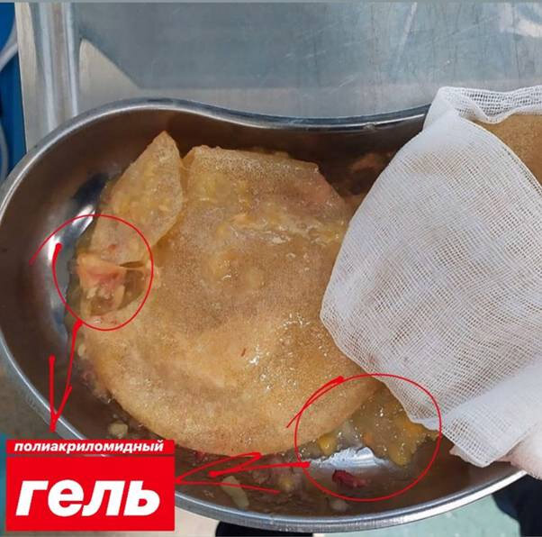 Это фото из Инстаграма Леры, на котором хорошо видны не только извлеченный имплант, но и частицы полиакриламидного геля