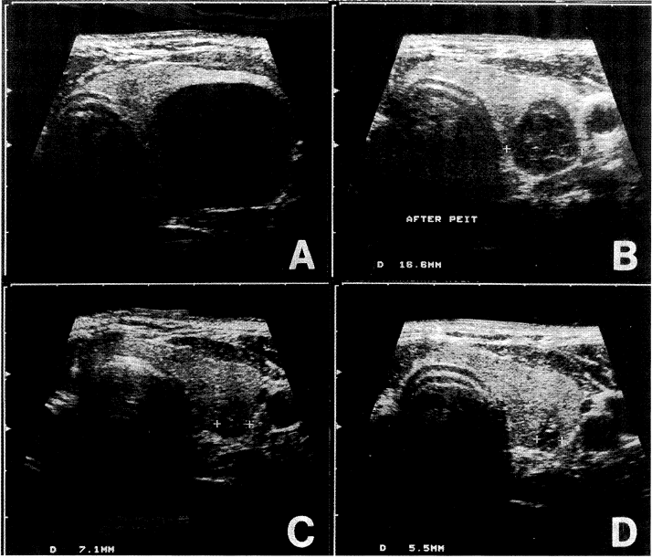 Рисунок из статьи. Результат спиртовой склеротизации узла щитовидной железы по этапам.