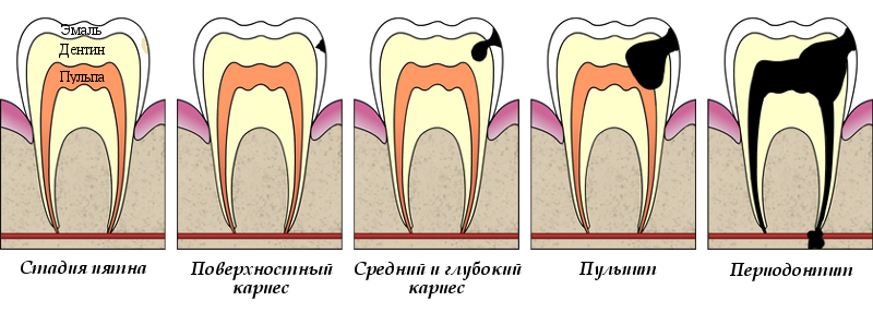 Стадии заболевание зуба.