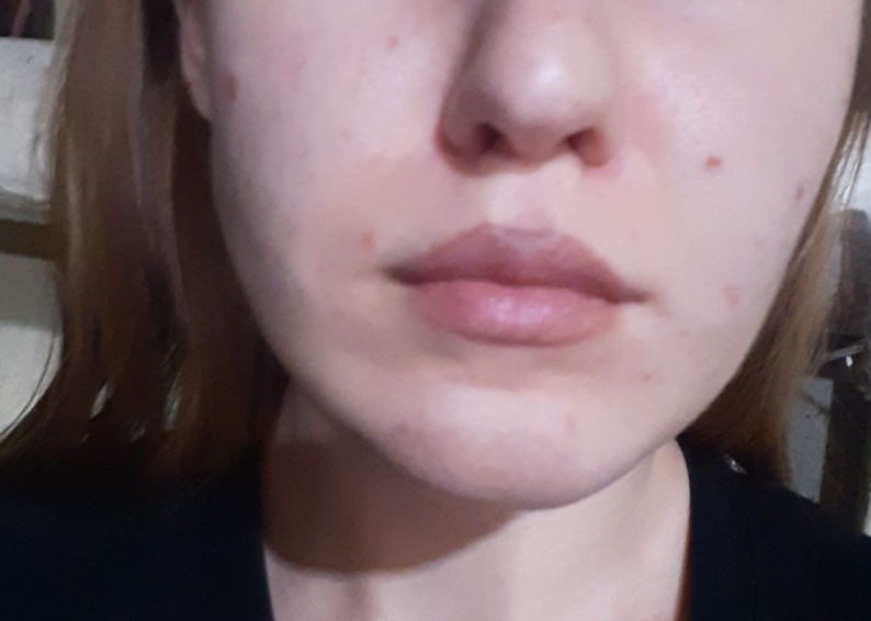 Мой результат после ванночек раз в месяц, так как кожа очень сухая. 