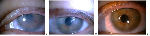 Пациентка С., 24 года, диагноз: офтальморозацеа, кератит, неоваскуляризация роговицы; до криолечения (а), через 2 месяца после двух сеансов криотерапии № 10 (б) и через 1 год после 5 сеансов криотерапии (в).