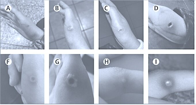    Кожные поражения у пациенток с оспой обезьян / © John Thornhill et al., 2022