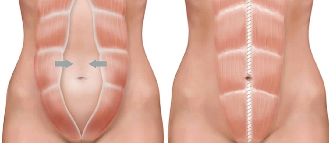 Слева диастаз, справа норма.