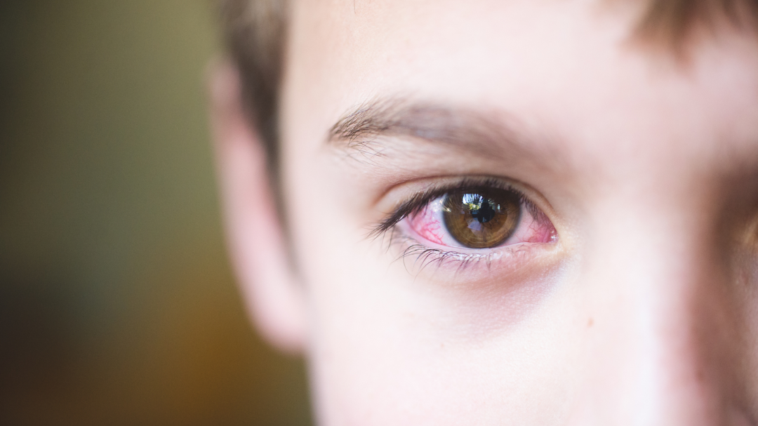 Причины покраснения глаз у детей.