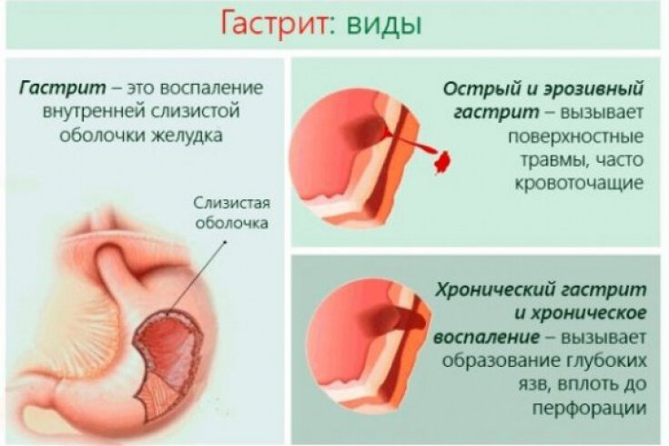 Какие лекарства можно использовать при болях в желудке | Блог «Государственной аптеки»