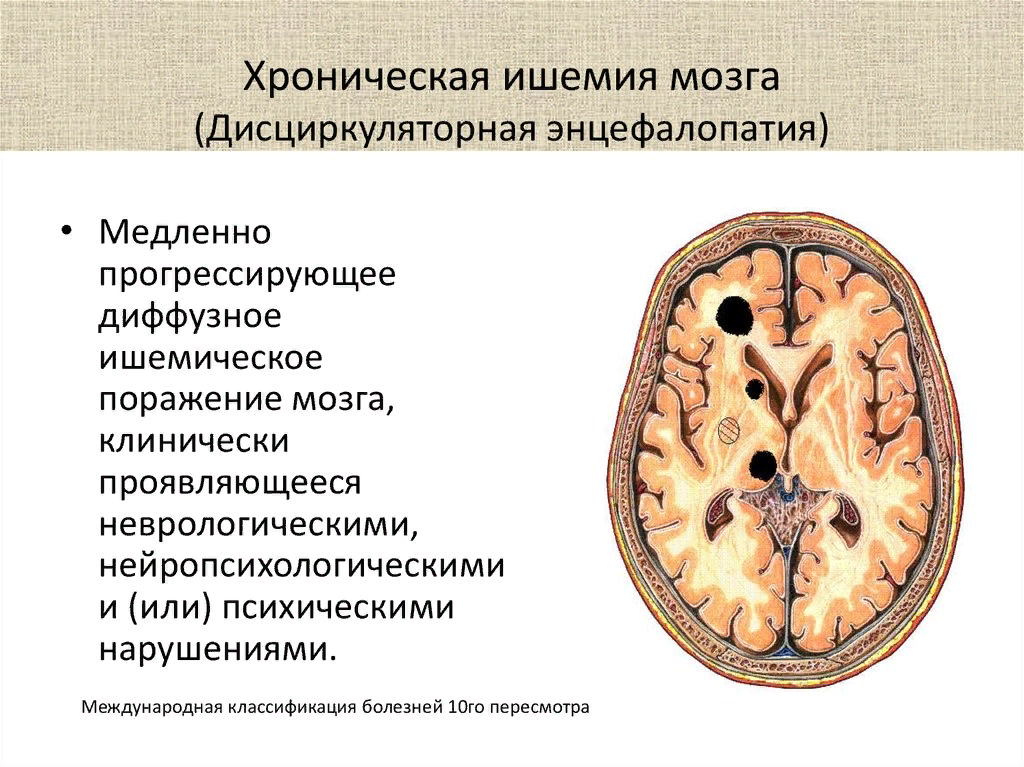 Схема лечения ишемии головного мозга препараты