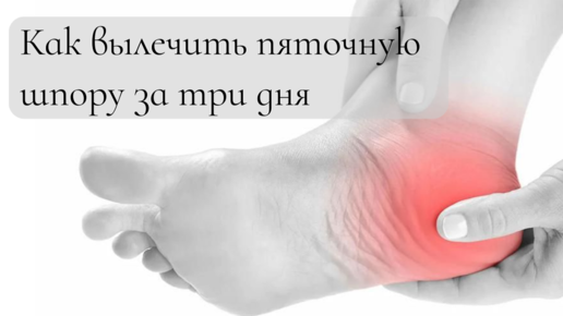 Как можно вылечить шпору на пятке. Шпора на пятке чем лечить. пяточная шпора что это и как лечить. пяточная шпора как вылечить быстро.