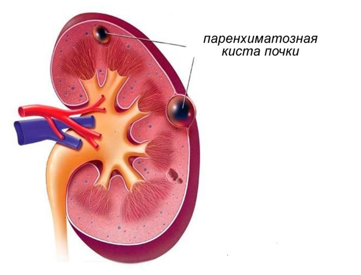 Кисты почки нужна ли операция