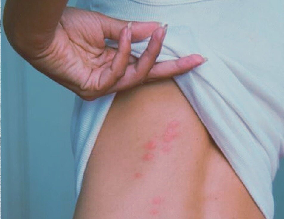 Укусы сколопендры