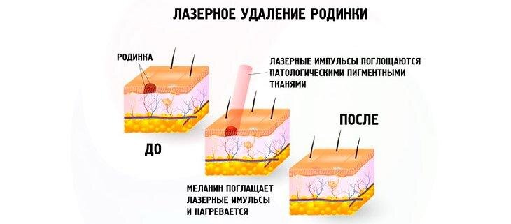 Сомнительное счастье, или как можно удалить родинку