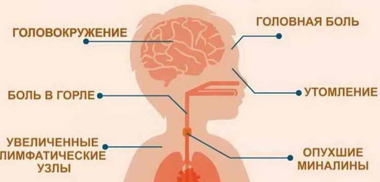 Горло при вирусе эпштейн барра фото Хронический мононуклеоз - особенности клиники и диагностика Мир мам: блог педиат