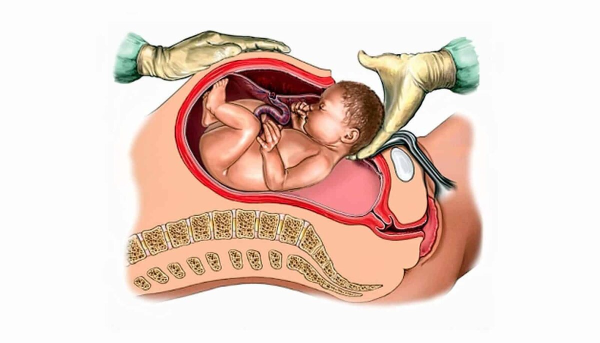 При каком предлежании делают кесарево. Рождение ребенка кесарево сечение. Экстренное кесарево сечение. Роды через Естественные родовые пути.
