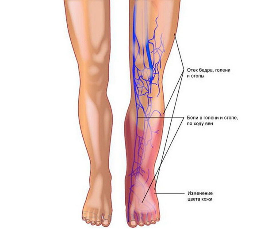 Тромбоз поверхностных вен нижних конечностей