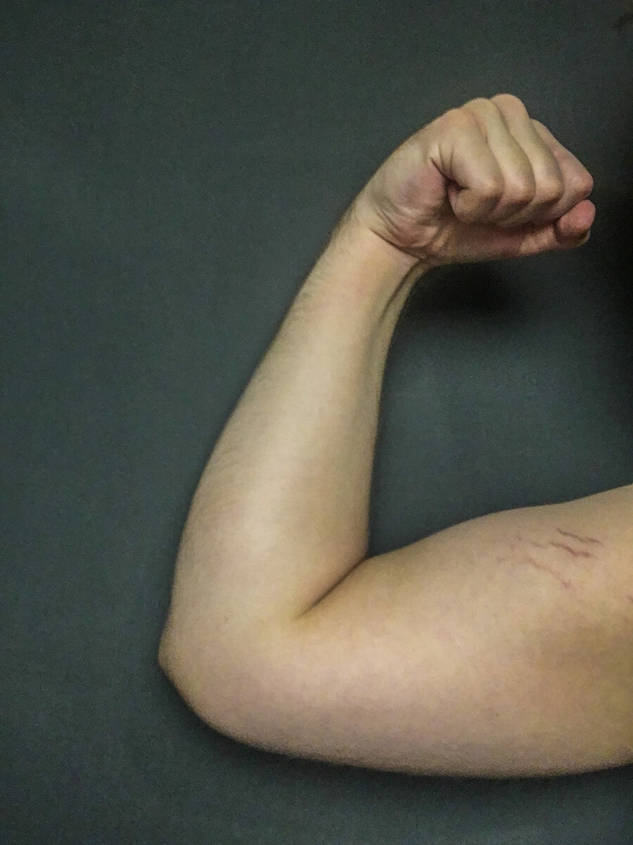 На фото вы можете увидеть типичный признак лишнего веса-растяжки на руке