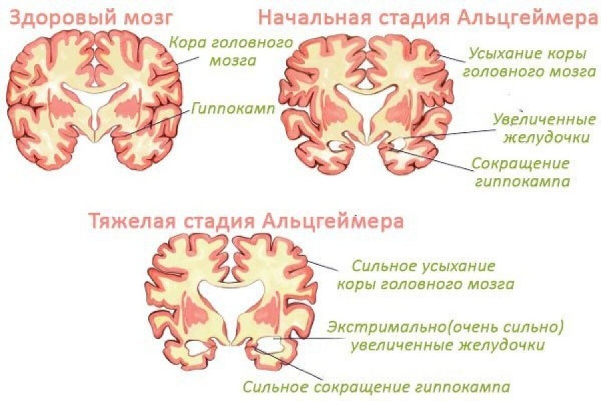 Болезни мозга степени