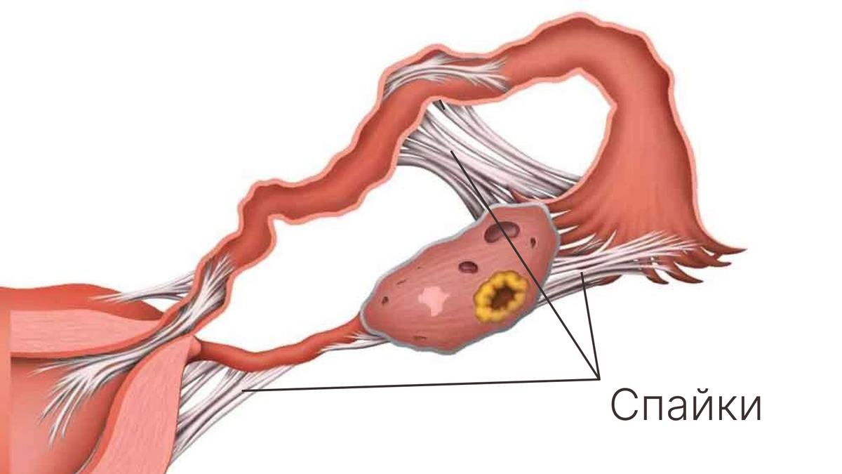 Спайки у женщины причины. Эндометриоз спаечный процесс. Эндометриоз маточных труб. Спаечный процесс в маточных трубах.