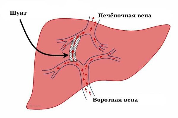 ТИПС (трансъюгулярное внутрипеченочное портосистемное шунтирование)